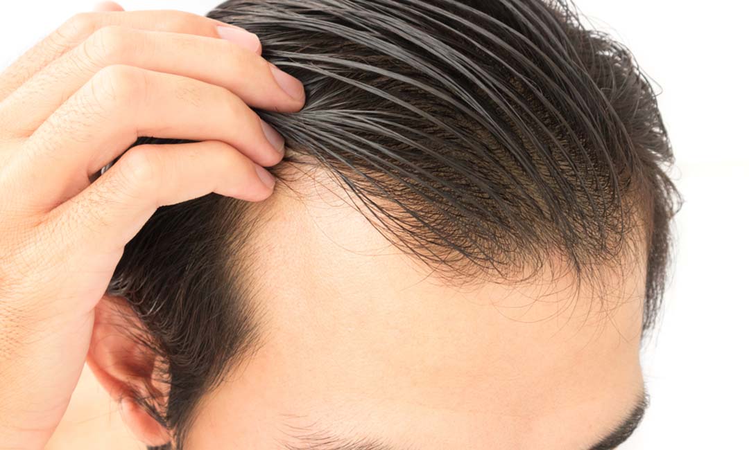 13 Best & Worst Female Hairstyles For A Receding Hairline - Wimpole Clinic
